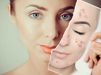 lightening peel