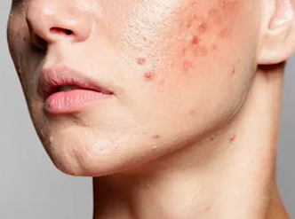 terapia acne e imperfecciones